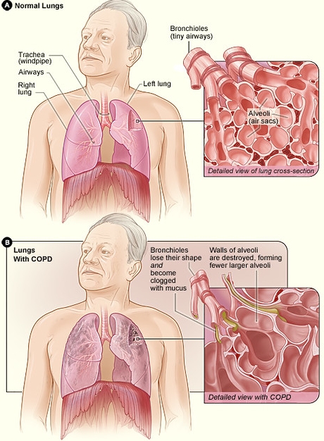 만성 폐쇄성 폐질환(COPD) 이해: 증상 및 원인1