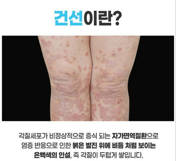  겨울철 대표 피부질환 건선의 치료와 예방법