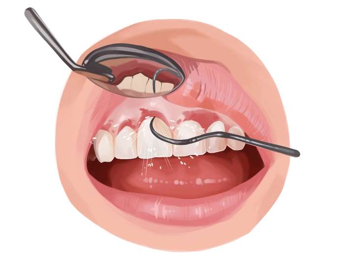 잇몸 질환