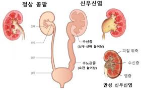 오른쪽-옆구리-통증-의심되는-병