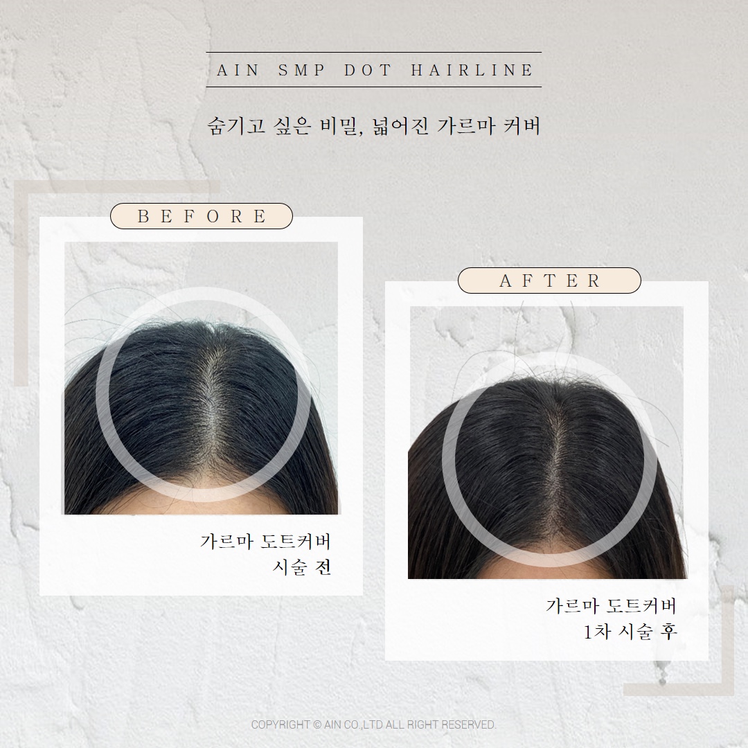  헤어라인 고민은 아인뷰티랩에서 해결하세요~