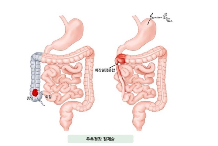 우측결장절제술