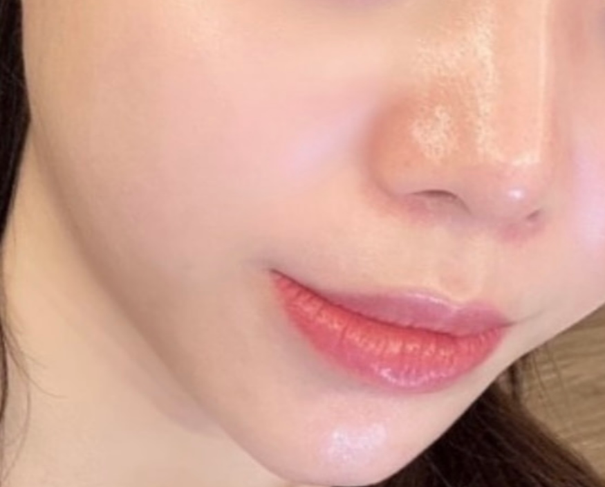  리쥬란 효과 얼마나 가나요?