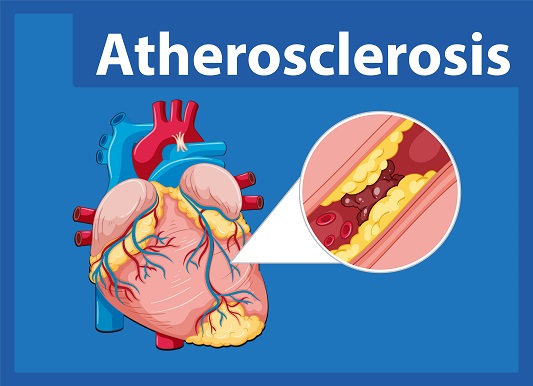 Angina-pectoris