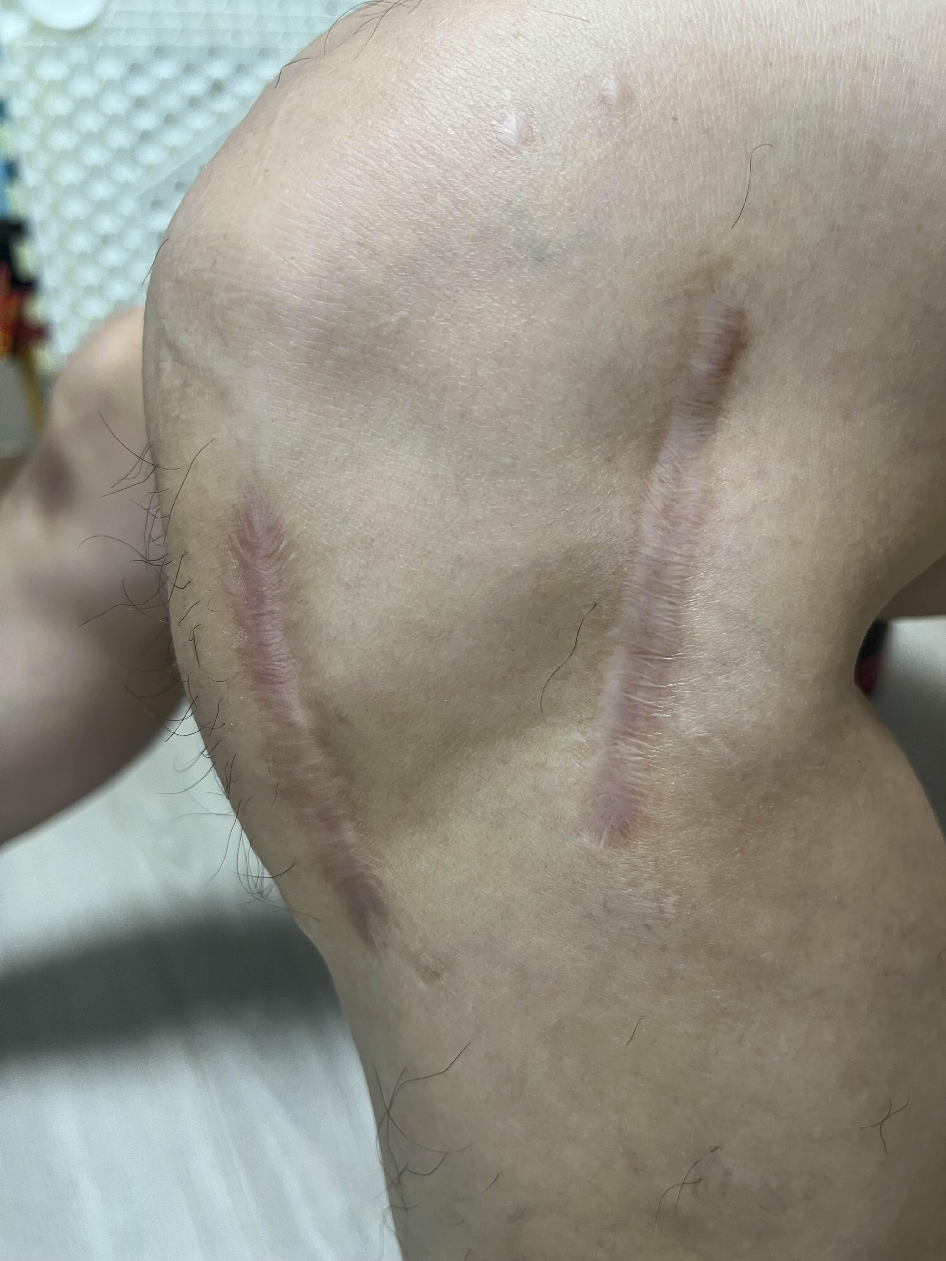  [경험담] 8시간에 걸친 무릎 연골판 이식수술 받은 후기