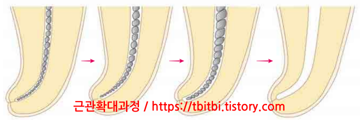 근관확대과정