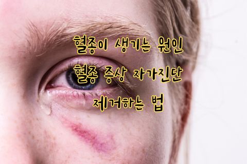 혈종 원인 및 증상, 제거하는 법