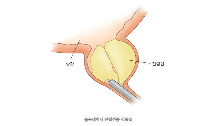 전립선 비대증 수술 비용