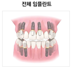  [전체임플란트] 식립개수, 가격, 비용, 잘하는 치과 찾는 법