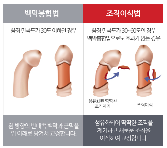 음경만곡증 치료 안해도 될까?