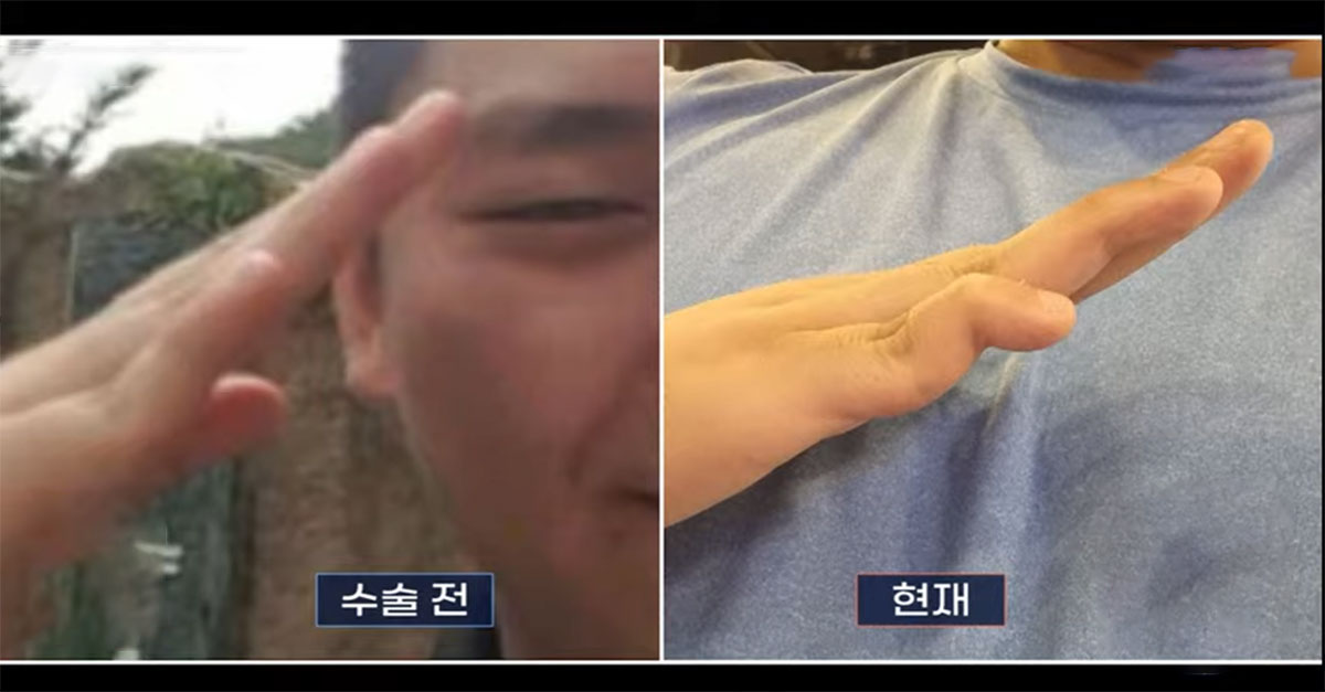  군대에서 수술받고 손가락 영구 장애받은 사람..