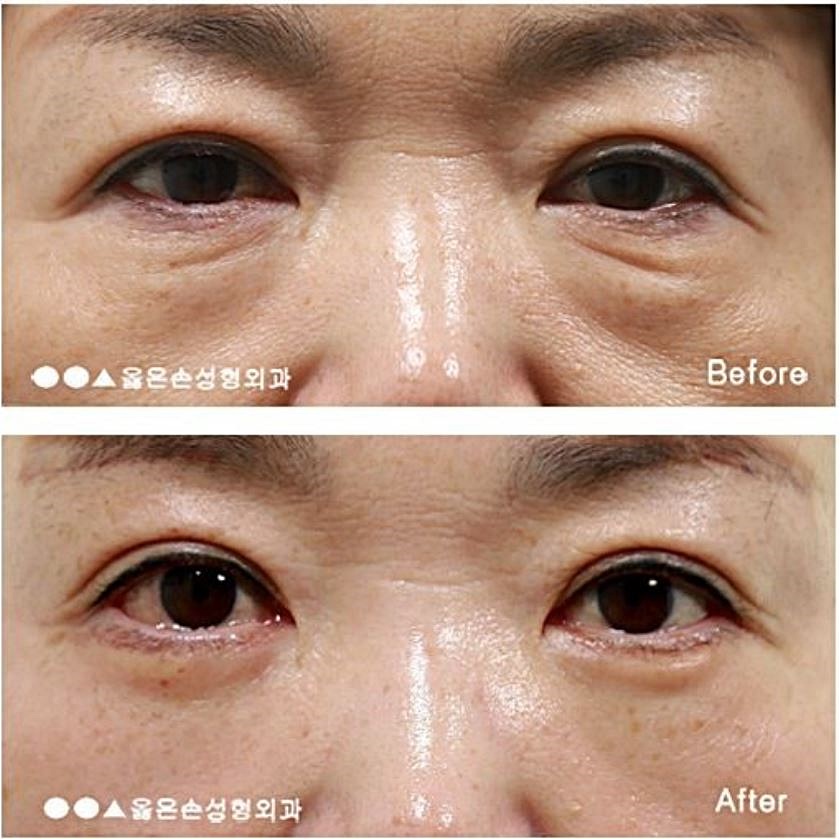 상안검 수술 후기 반드시 참고해야 한다 8