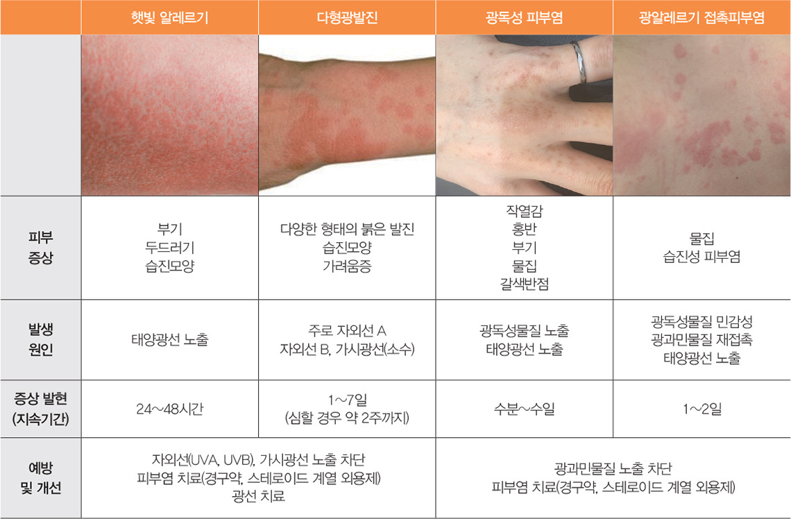 햇빛 알레르기 증상