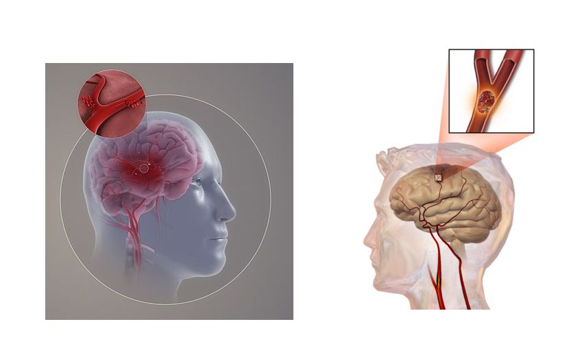 뇌출혈의 종류 그래픽