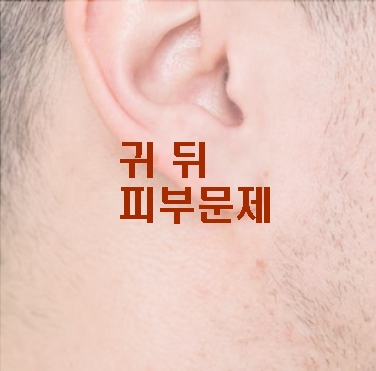 피지낭종