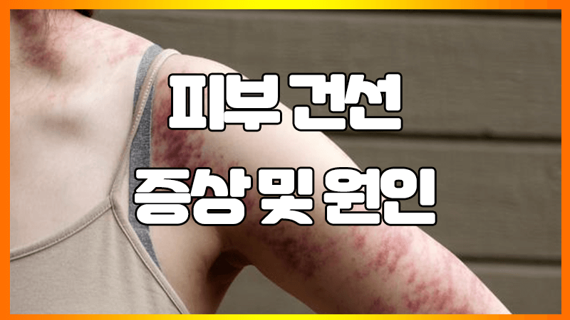  피부 건선 증상 정리 : 손톱, 두피