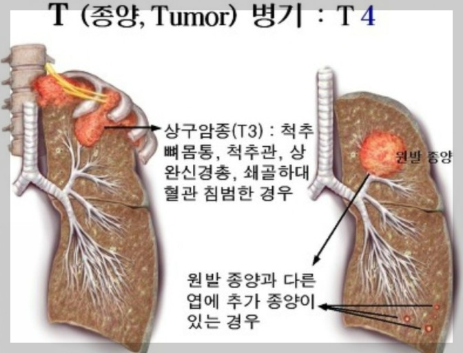 호흡기 질환: 폐렴- 초기증상, 원인, 1기~말기까지 진행과정, 치료방법, 수술방법.