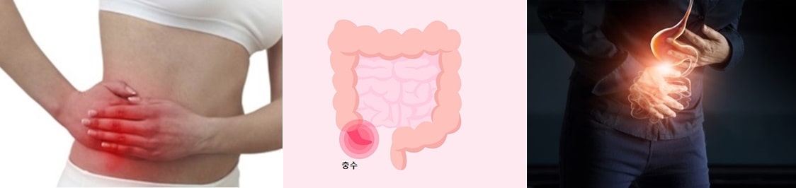 충수염 증상&#44; 오른쪽 아랫배 극심한 통증