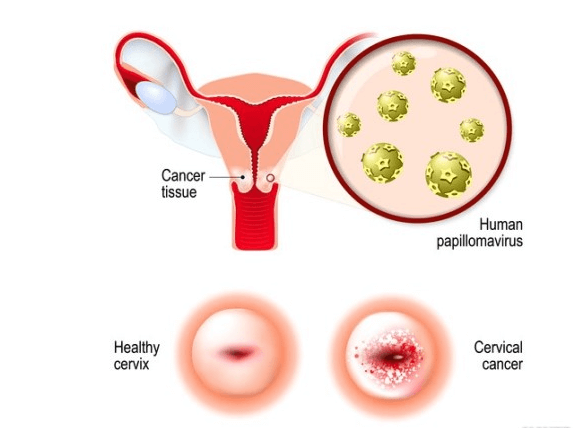 자궁경부암 원인,증상,진단,예방
