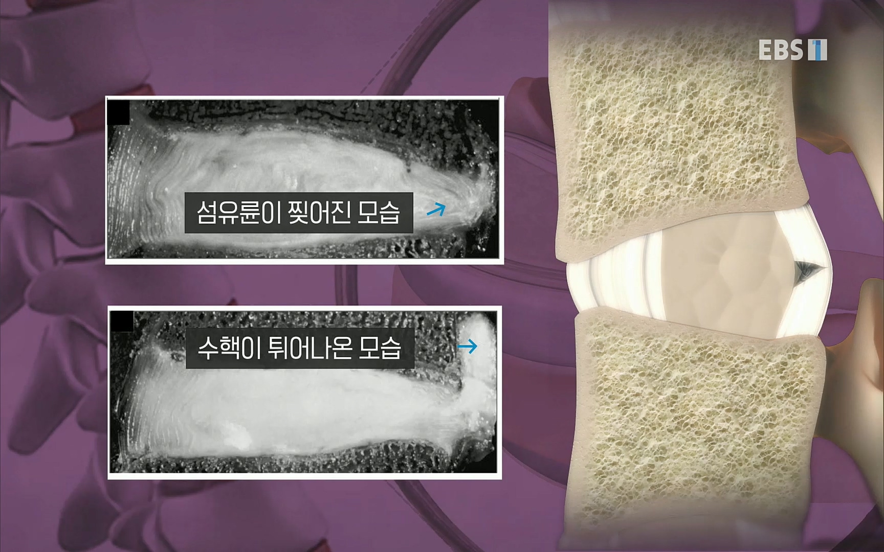 EBS 명의 헬스케어 - TV - 교육의 중심 EBS허리 통증 치료 프로젝트 1부, 수술없이 낫는다 .mp4_20220712_204223.962.jpg