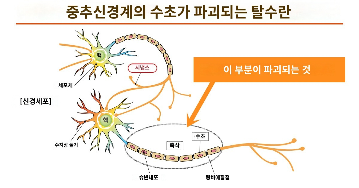 다발성경화증 줄기세포