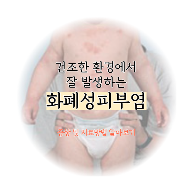 화폐성피부염