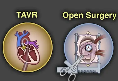 TAVR versus SAVR