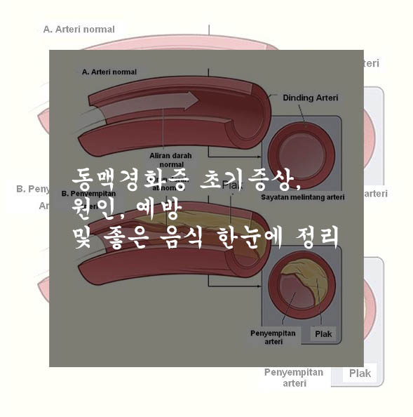  동맥경화증 초기증상, 원인, 예방 및 좋은 음식 한눈에 정리