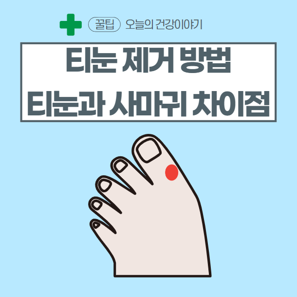  티눈 제거방법 사마귀와 차이점