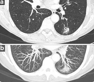 폐암과 폐 결절