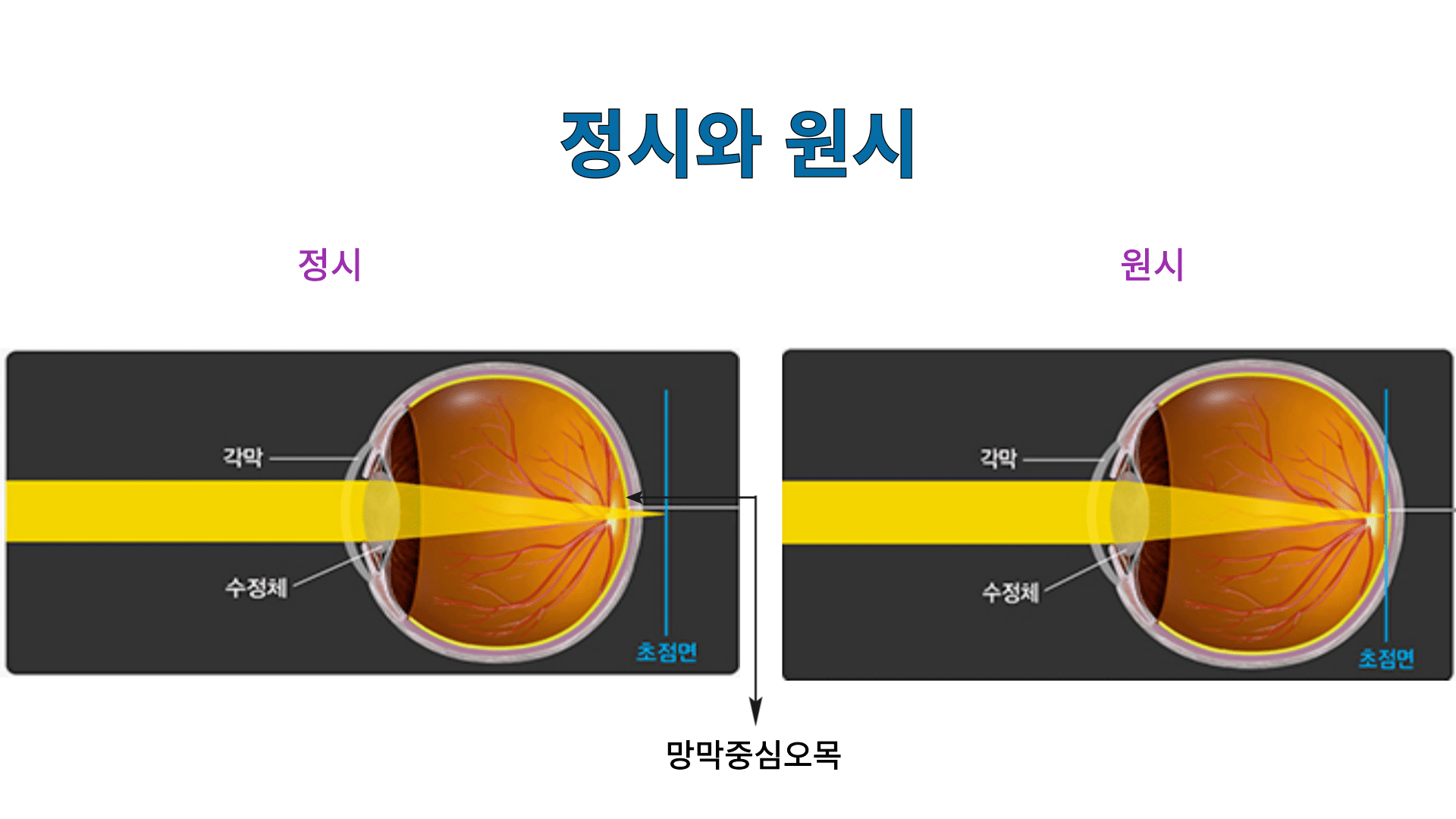 왼쪽은 정상 시력을 나타내며, 빛이 각막과 수정체를 통해 망막 중심에 초점을 맞추는 모습을 보여줍니다. 오른쪽은 원시를 설명하며, 눈이 짧아지면서 빛이 망막 뒤쪽에 초점이 맞춰지는 과정을 나타냅니다.