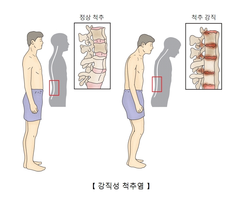 강직성 척추염 진단 방법