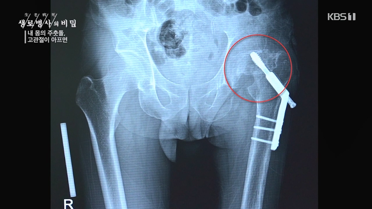 생로병사의 비밀.E890.231116p-NEXT.mp4_20231116_204856.110.jpg