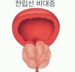  전립선비대증 증상 원인과 치료 방법 전립선에 좋은 음식