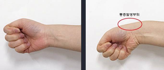 손목건초염자가진단법
