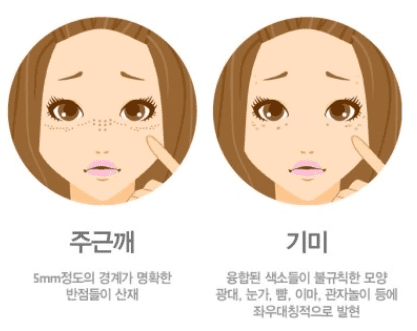  기미 주근깨 원인 예방 차이점 치료 가격 / 기미 주근깨 A~Z까지!