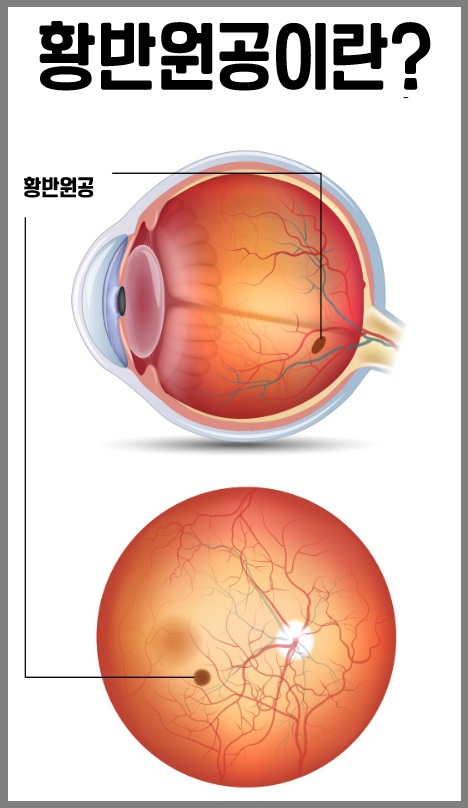 황반원공