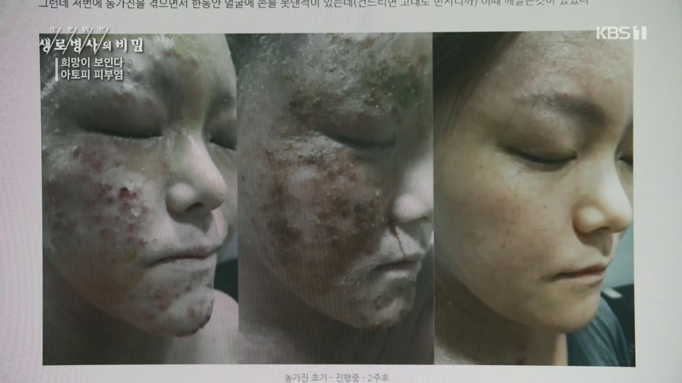 생로병사의 비밀.E872.230628p.H264-F1RST.mp4_20230707_214230.437.jpg