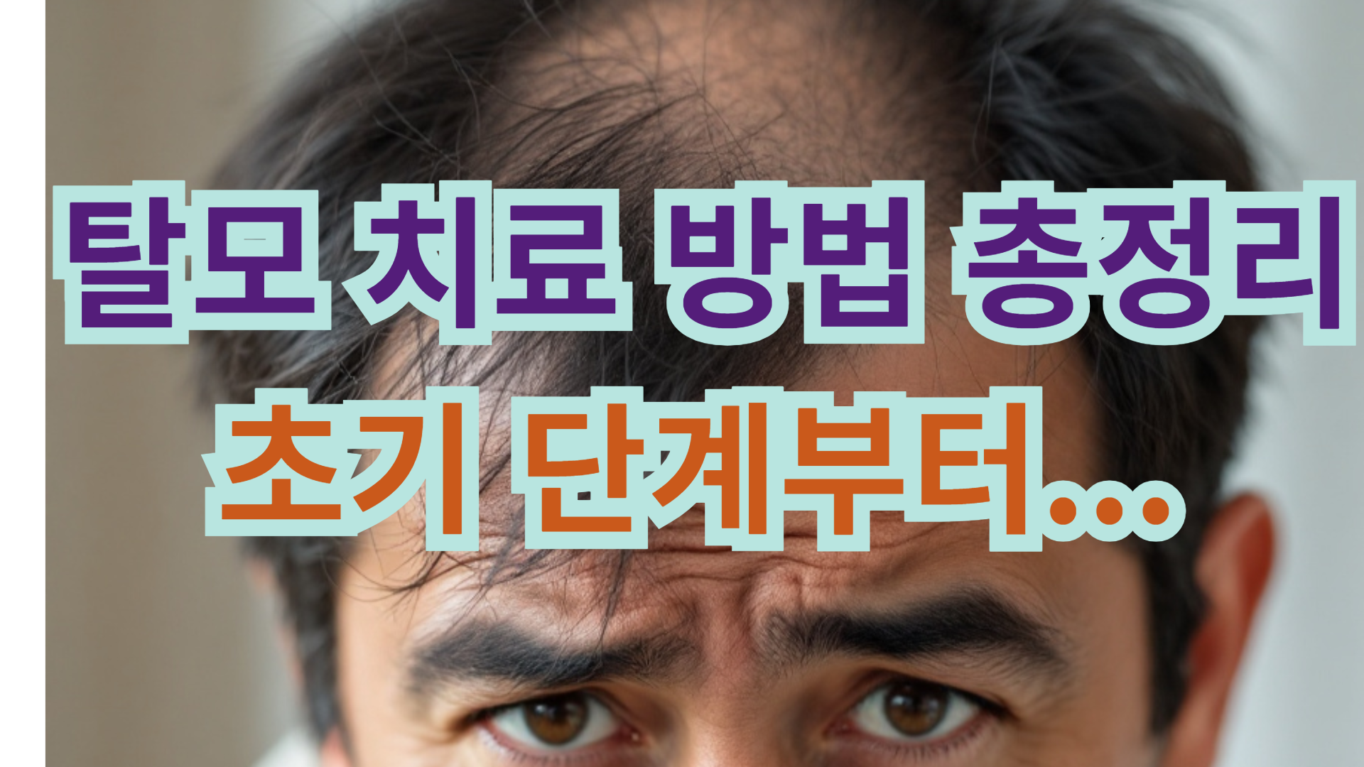 탈모 치료 방법 총정리