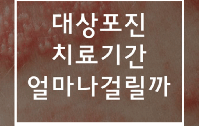 대상포진-치료기간