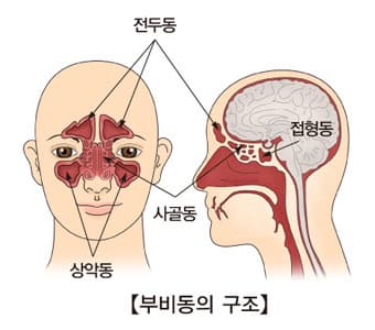 축농증 증상