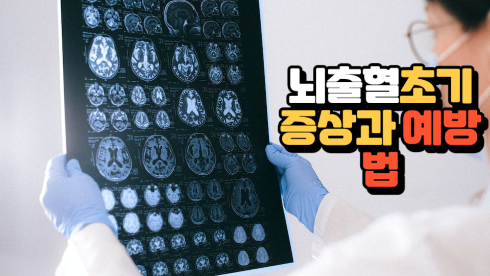  우리가 간과하는 뇌졸증 초기 증상과 예방법