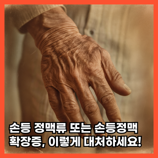 손등정맥 확장증