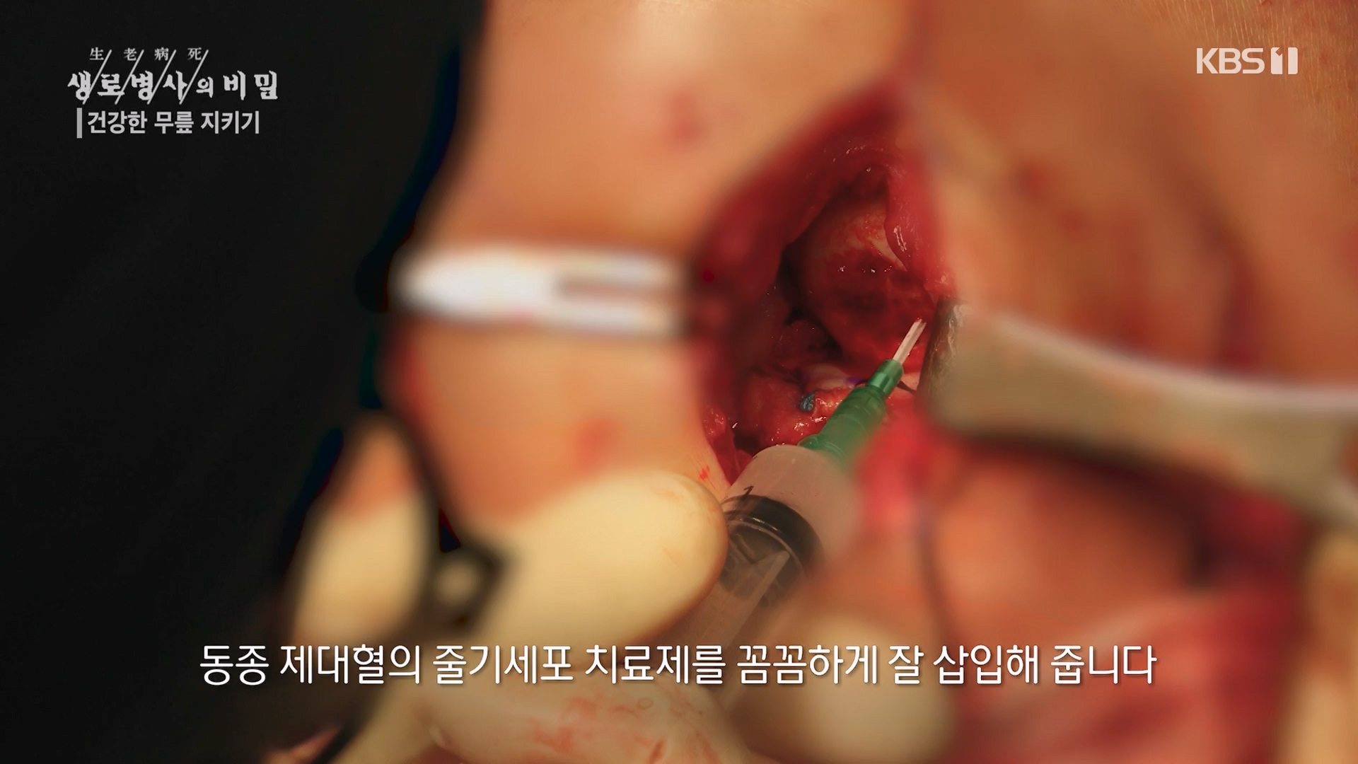 생로병사의 비밀.E873.230607p-NEXT.mp4_20230608_202211.344.jpg