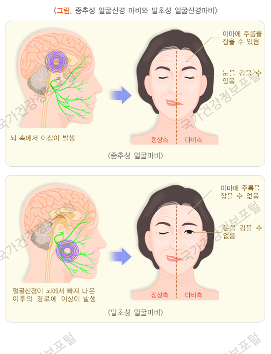 벨 마비와 뇌졸중의 안면 마비 비교
