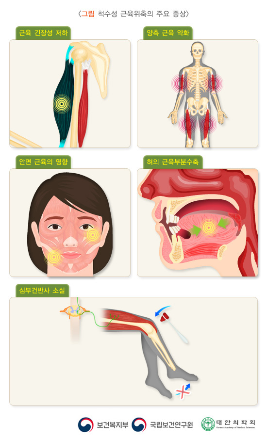 Symptoms of Spinal muscular atrophy