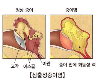 한쪽 귀에 난청