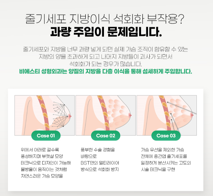 줄기세포 지방이식 석회화 부작용은 과량 주입이 원인입니다.