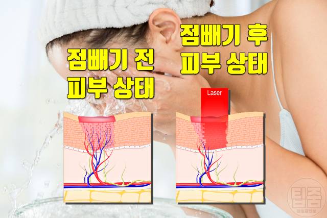 점 빼고 관리 색소침착 패인 흉터 점빼고 세수