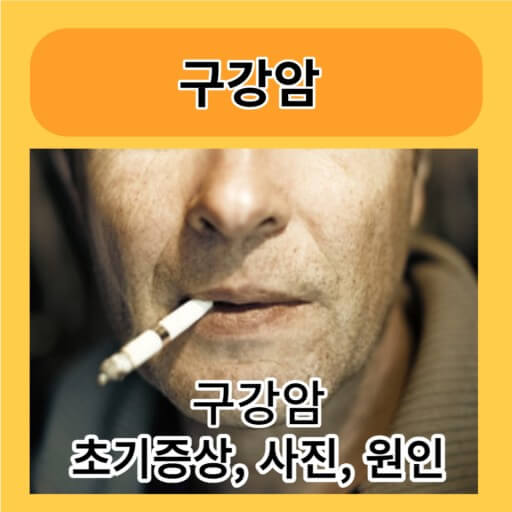 구강암의 원인